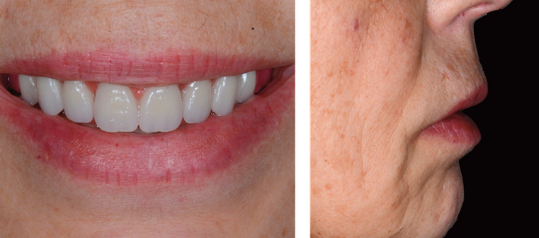 dents-anterieures-maxillaires