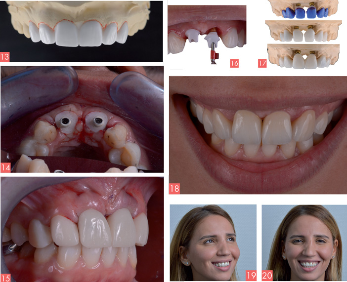 extraction-des-dents