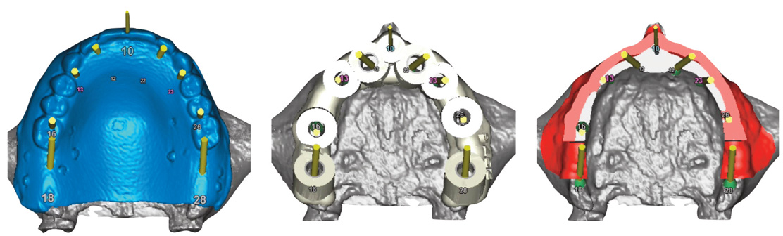 guide-stereolithographique