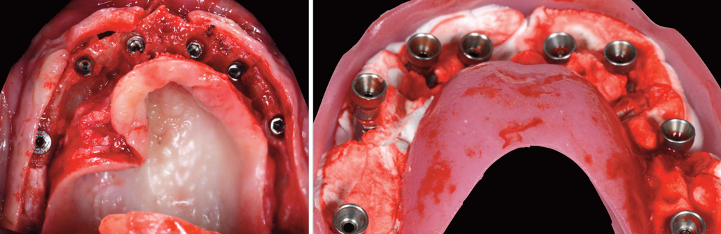 implants-dans-le-volume-osseux