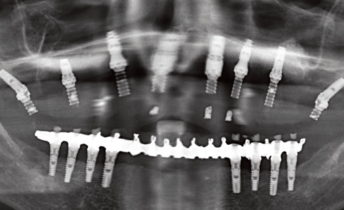 orthopantomogramme-de-controle