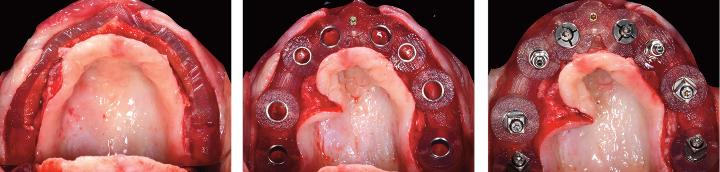 resection-osseuse-effectuee