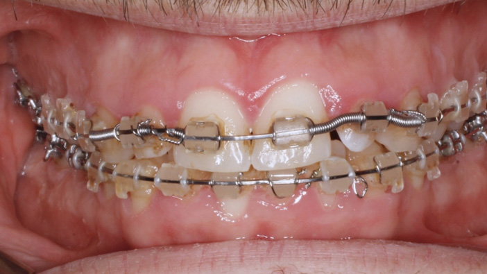 traitement-orthodontique
