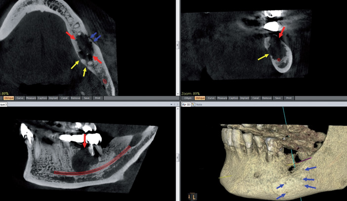 Carcinome-épidermoïde-gingival