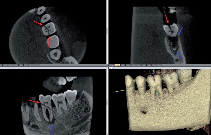 Fracture-coronoradiculaire