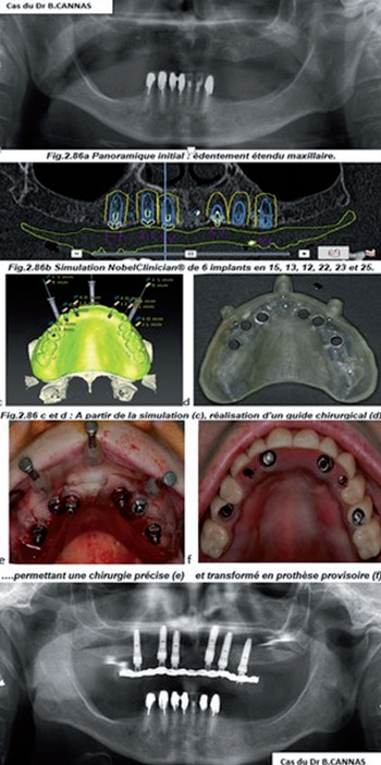 Implantologie-Chirurgie-guidée