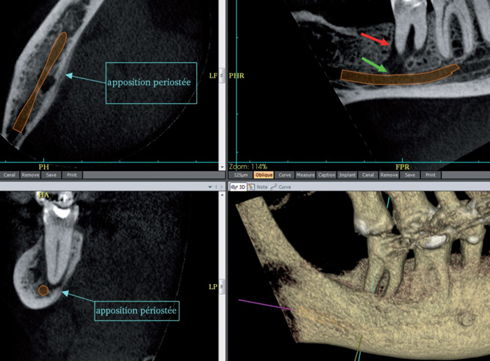 Lésion-endoparodontale