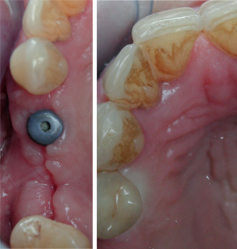 Aabsence-d-integration-de-l-implant