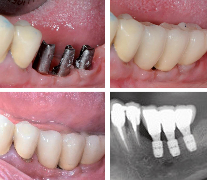 Controle-radiographique-post-prothetique