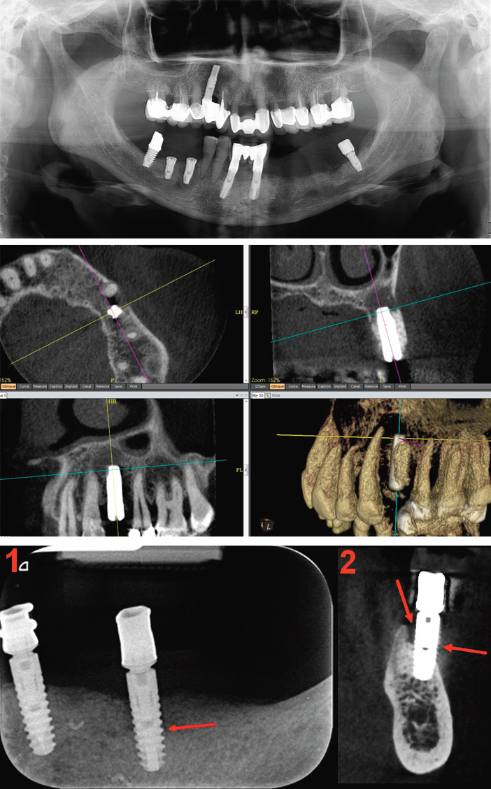 La-non-osteointegration