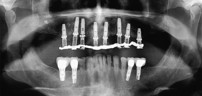 controle-initial-d-implants-multiples-maxillaires