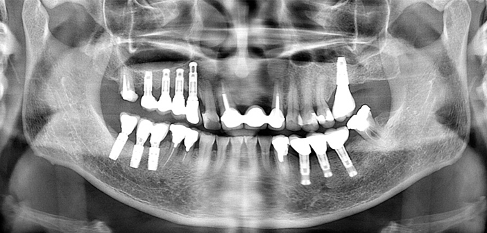 controle-radiographique-post-prothetique