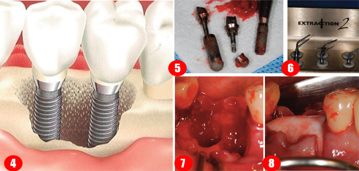 depose-des-implants