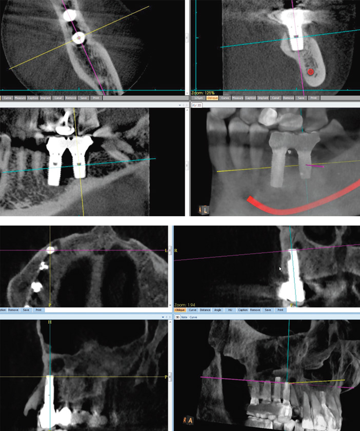 echec-secondaire-de-l-implant