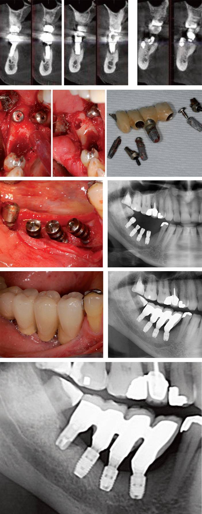 examen-Cone-Beam-controle-radiographique-post-prothetique