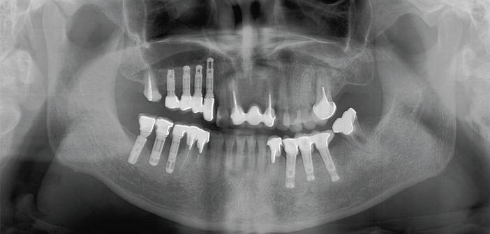 examen-radiographique-des-maladies-peri-implantaires