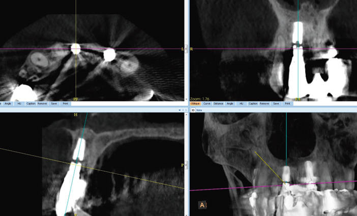 fracture-de-l-implant