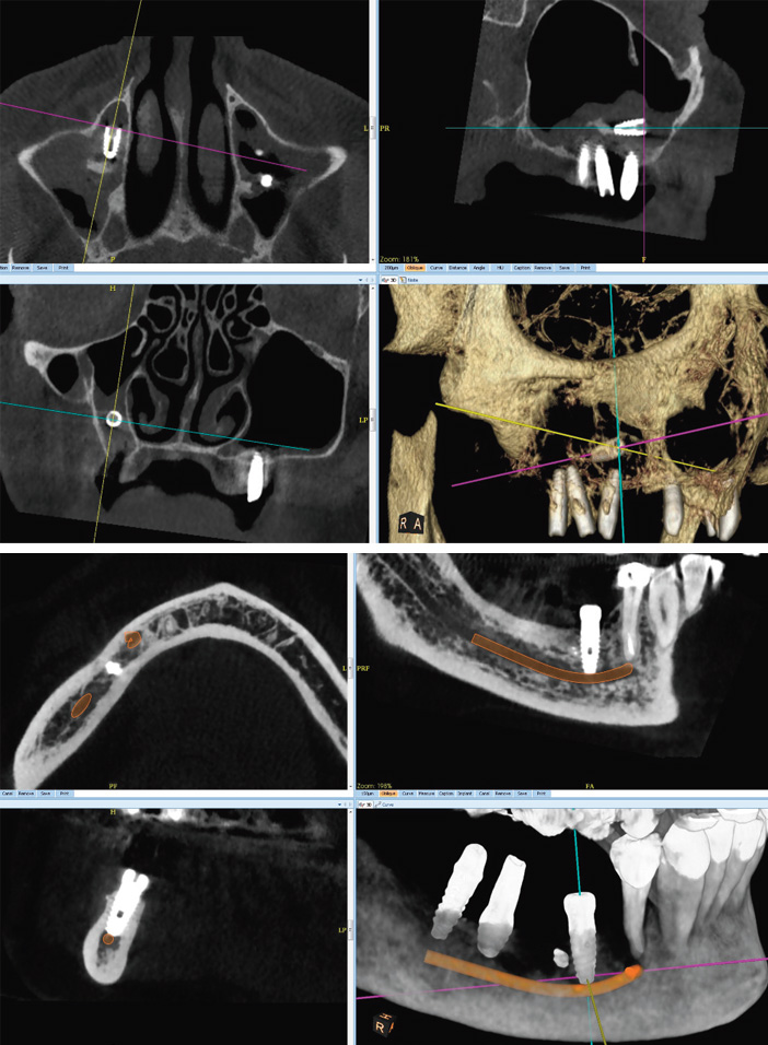 fuite-intrasinusienne-d-un-implant