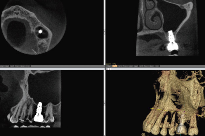 implant-asymptomatique