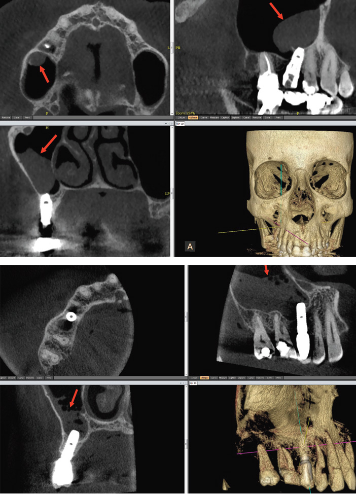 implant-legerement-oblique