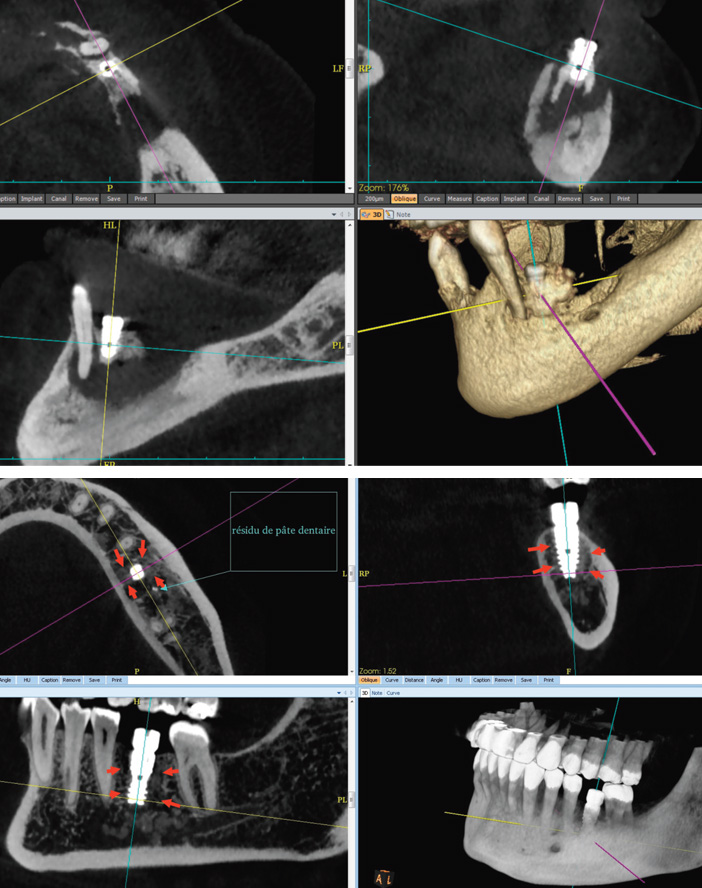 implant-mal-osteo-integre-cercle-de-fibrose