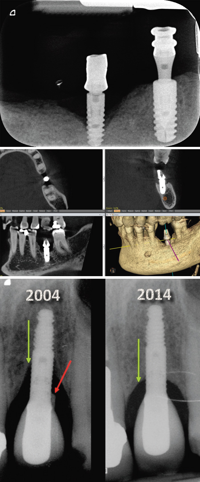 peri-implantite-typique