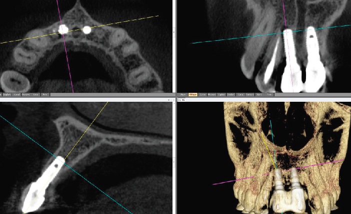 resorption de l-apex