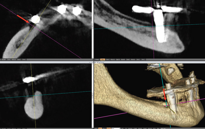 resorption-de-l-apex