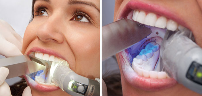 Le-scanner-intra-oral-en-CFAO