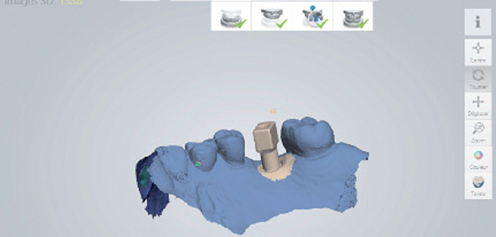 cfao sans risque prothese sur implant