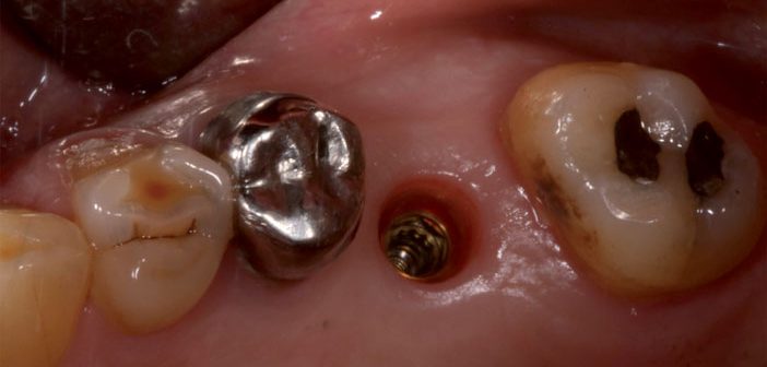 debuter cfao sans risque prothese sur implant