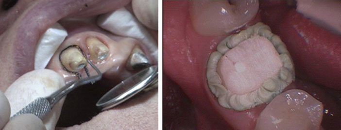 les-zones-subgingivales