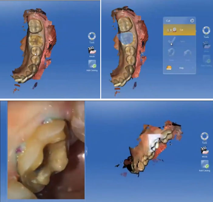 occlusion-et-la-correler-en-bouche.