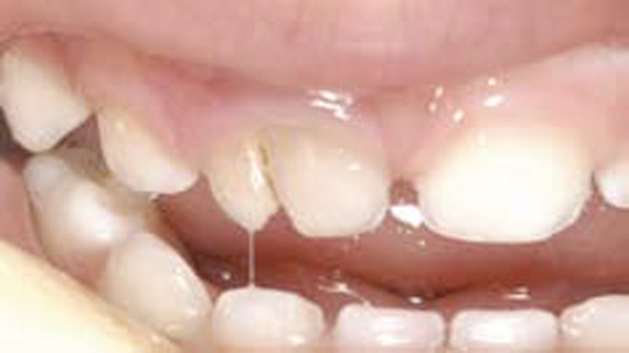 Traumatismes Et Dents Temporaires