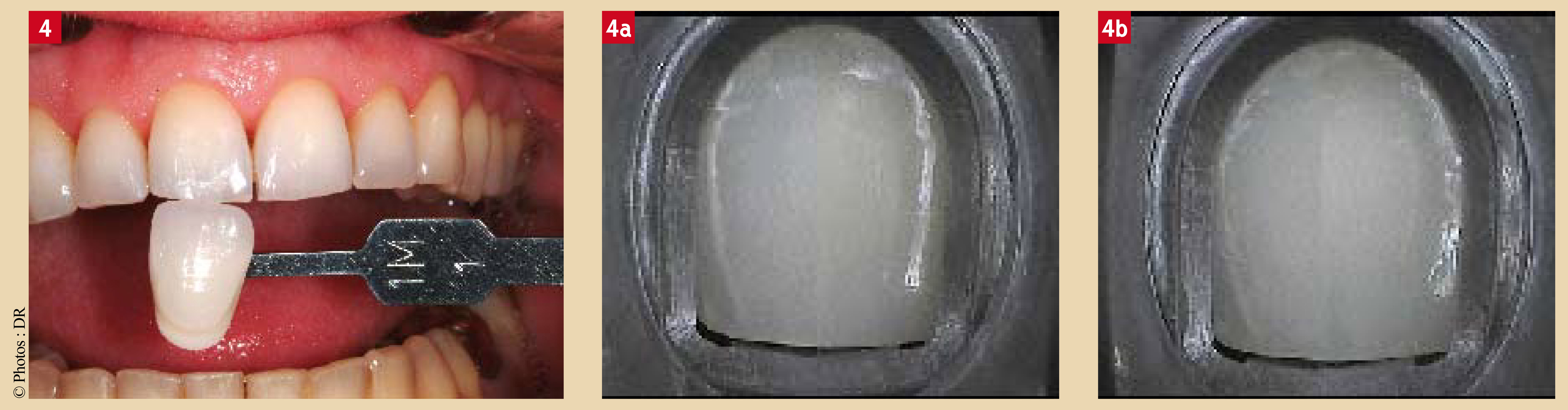 Quantification d’une technique d’éclaircissement sur dents pulpées à l