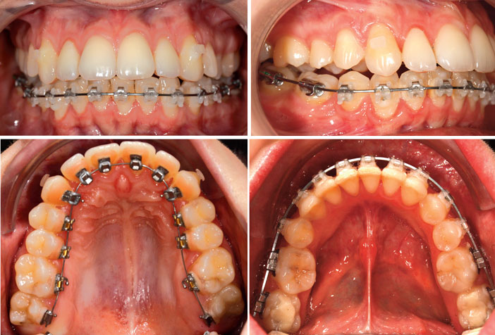 Cas-Clinique-avec-technique-mixte-JJ-Aknin