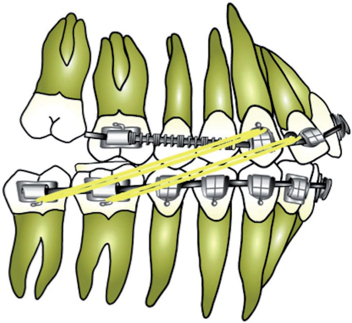 DAC-en-denture-adolescente-et-adulte-jeune-pendant-distalisation