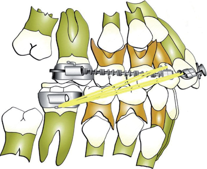 DAC-en-denture-mixte