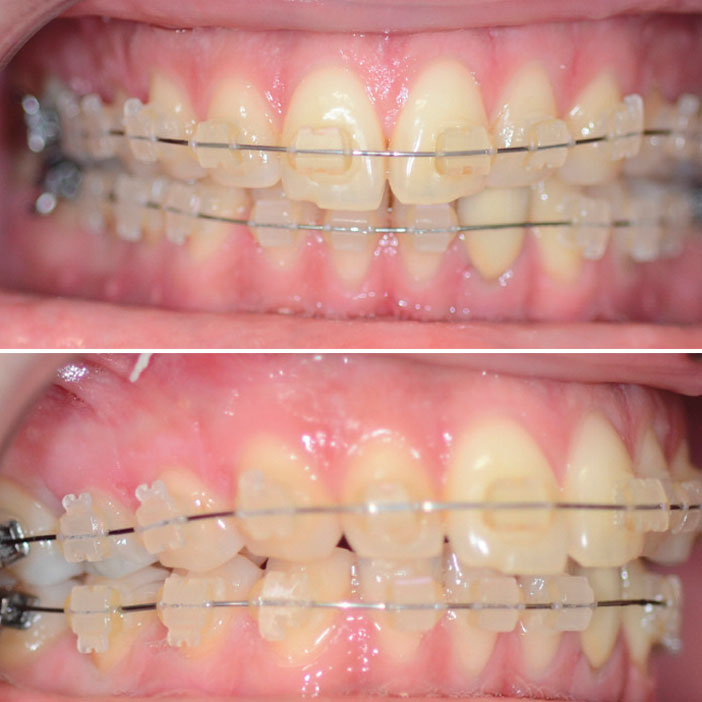 corticotomies-selon-notre-technique-mini-invasive