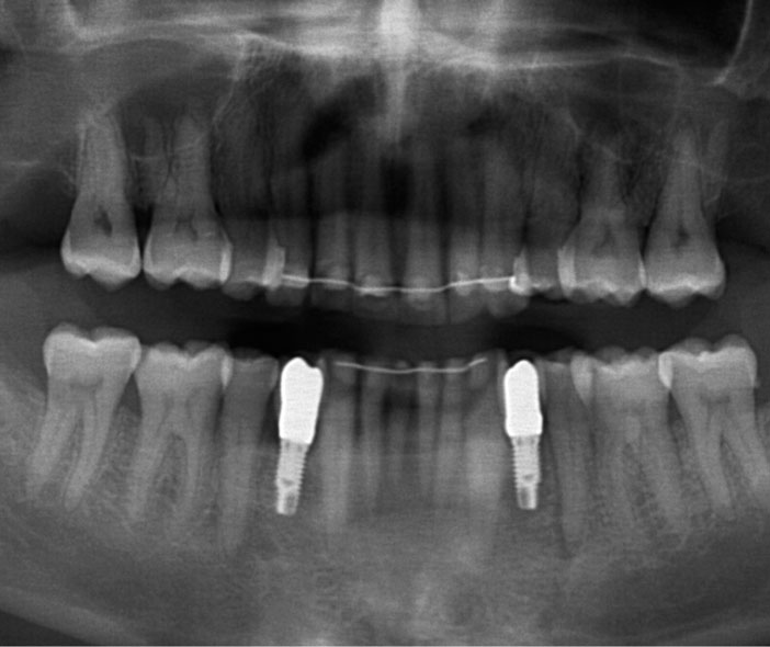 implants-en-34-et-44