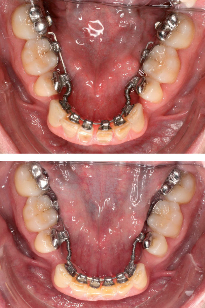 ouverture-des-espaces-a-la-mandibule