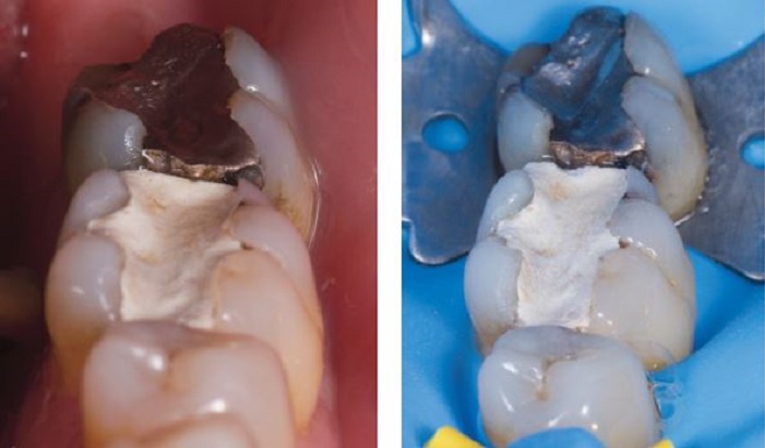 consultation initiale avec une sensibilite reversible