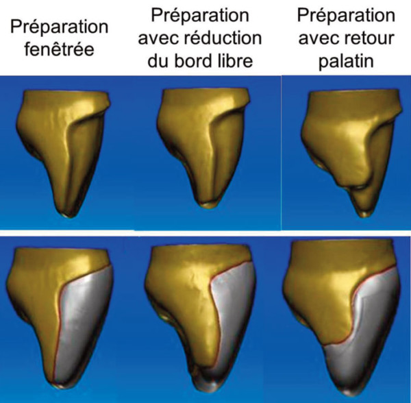 Protocole de préparation pour facettes — free download