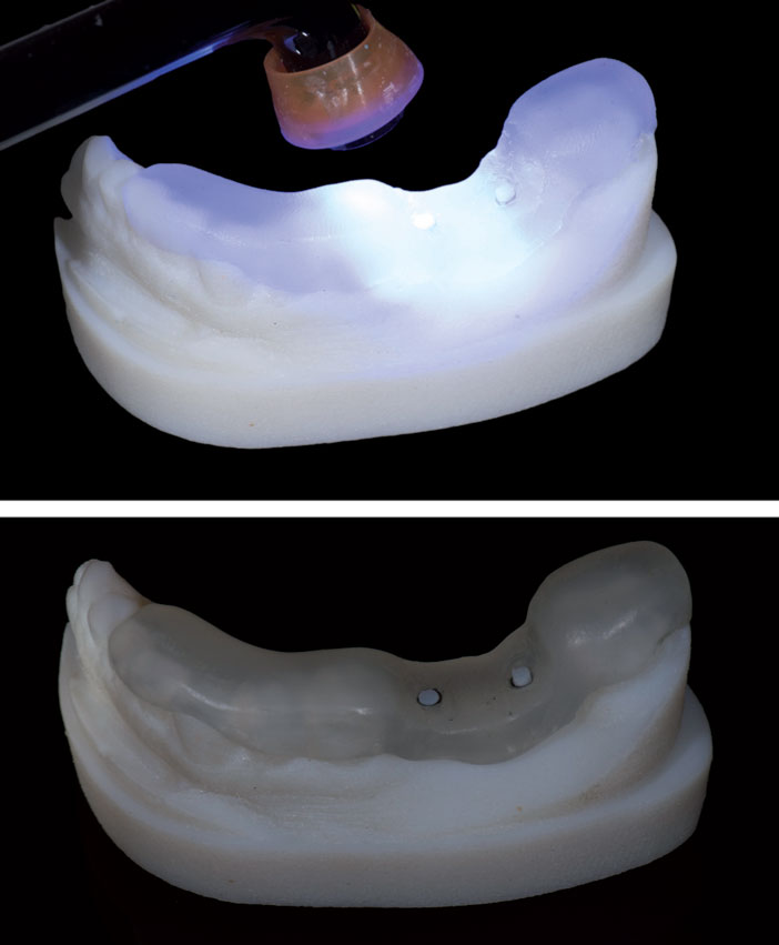 Les-dents-sont-recouvertes-de-composite-en-englobant-les-tubes