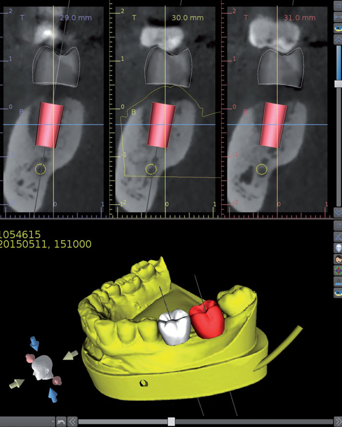 Positionnement-implantaire-a-partir-d-un-wax-up-virtuel
