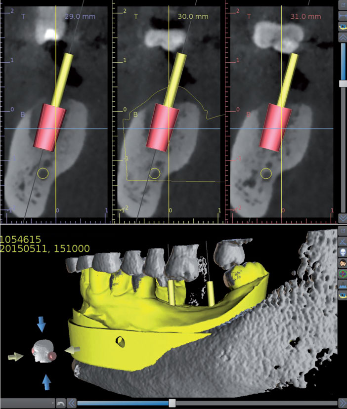 Tiges-modelises-au-niveau-de-l-axe-des-implants