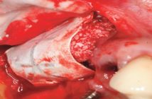 Augmentation osseuse 3D greffe de sinus associee a une rog