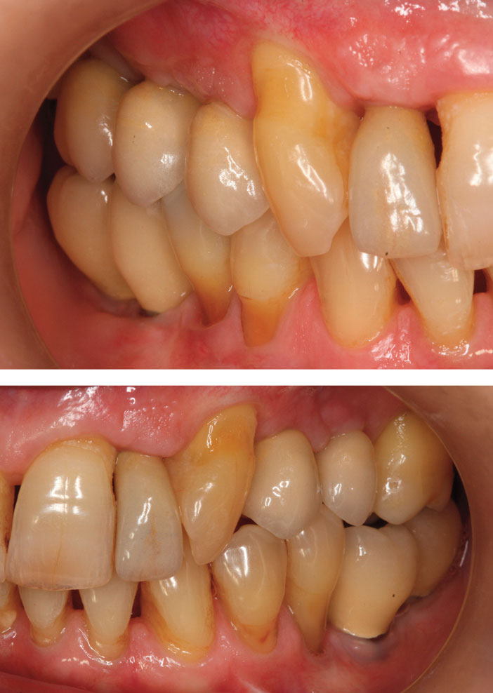 couronnes-ceramo-metalliques-transvissees-sur-implant