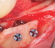 expansion-osseuse-horizontale-associee-a-la-pose-d-implants