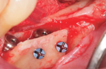 expansion-osseuse-horizontale-associee-a-la-pose-d-implants